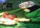 خارج کردن توده ۵ کیلویی از شکم مادر باردار گیلانی